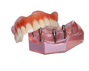 Model smile with All-on-4 dentures