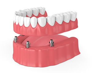 model of implant denture