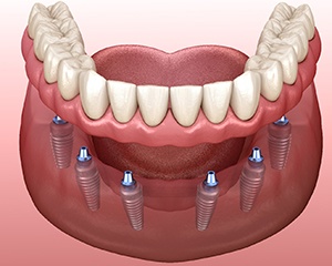 A digital image of an implant denture being placed over the top of 6 dental implants on the lower arch