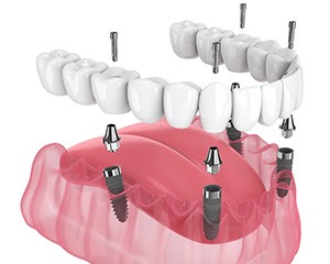 Illustration of an implant denture