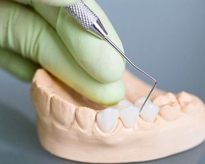 A mold of a dental bridge