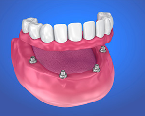 implant-retained denture