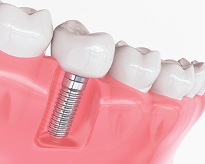Model of dental implants in Milwaukee. 