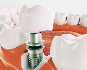 Digital illustration of a single dental implant being placed