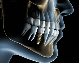 dental implant illustration