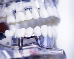 implant-supported bridge
