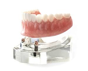 implant-retained denture