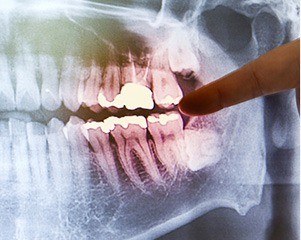 X-rays of tooth to be extracted