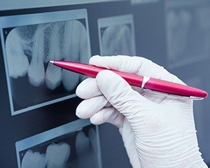 Pen pointing to digital dental x-rays