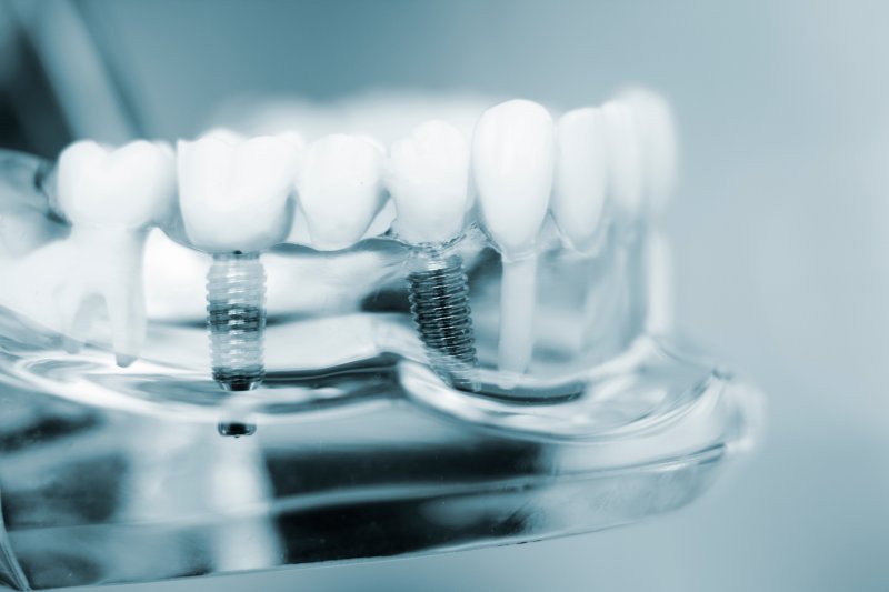 A close-up of dental implants in a model jaw