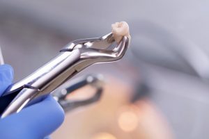 dentist holding a tooth in a dental instrument after performing a tooth extraction 