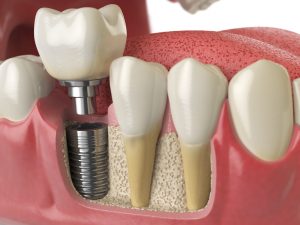 CGI image of a dental implant inserted next to other teeth with the crown separated from the abutment