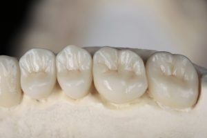 model of dental crowns on a mouth