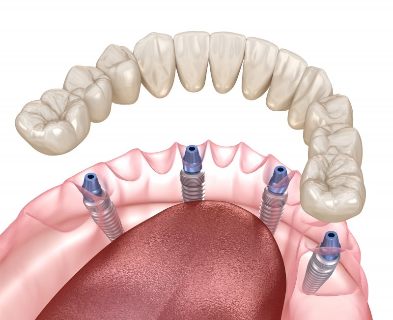 Illustration of dentures and all-on-4 implants