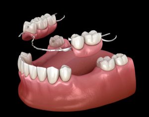partial denture replacing several missing teeth at once 