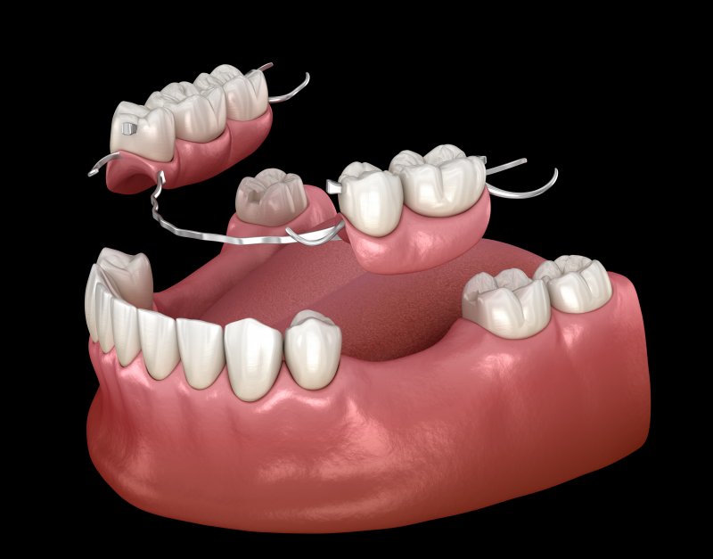 What Is the Difference Between Partial Dentures and Dental Bridges?