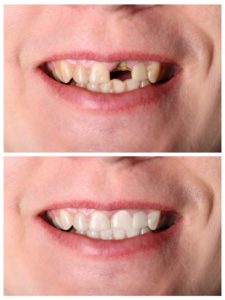 before and after picture dental crown