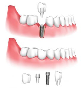 Do your smile gaps hurt your self-image? Restore your smile with beautiful dental implants from expert dentist in Milwaukee, Barry R. Franzen DDS.