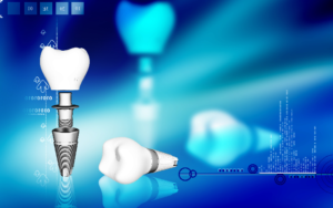 Image of dental implant
