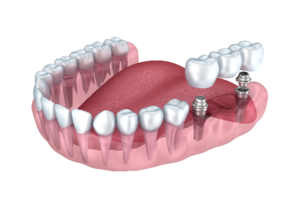 implant supported bridge