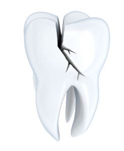 cracked tooth dental pain