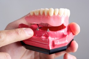 dental implants in Milwaukee