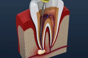 Root canals can prevent tooth extractions in Milwaukee.